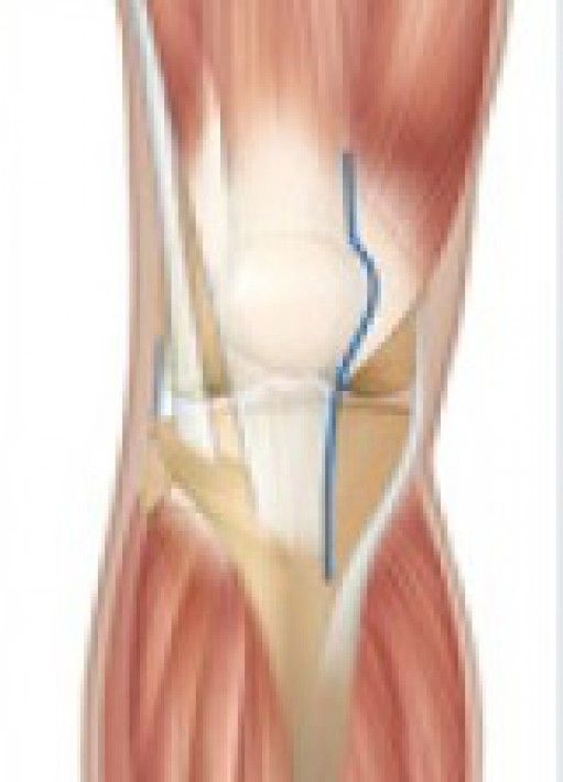Jean-Noël Argenson - Prothèse totale de genou en mini-invasif