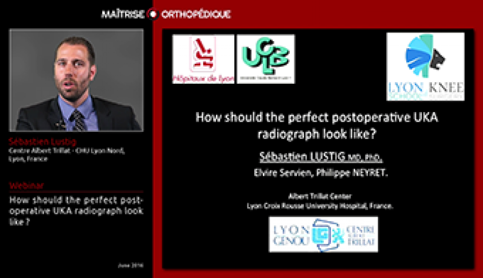 How should the perfect postoperative UKA radiograph look like?