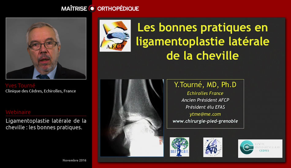 Ligamentoplastie latérale de la cheville : les bonnes pratiques