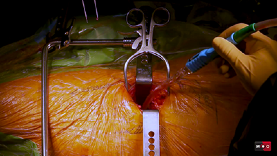 Bikini et voie de Hueter