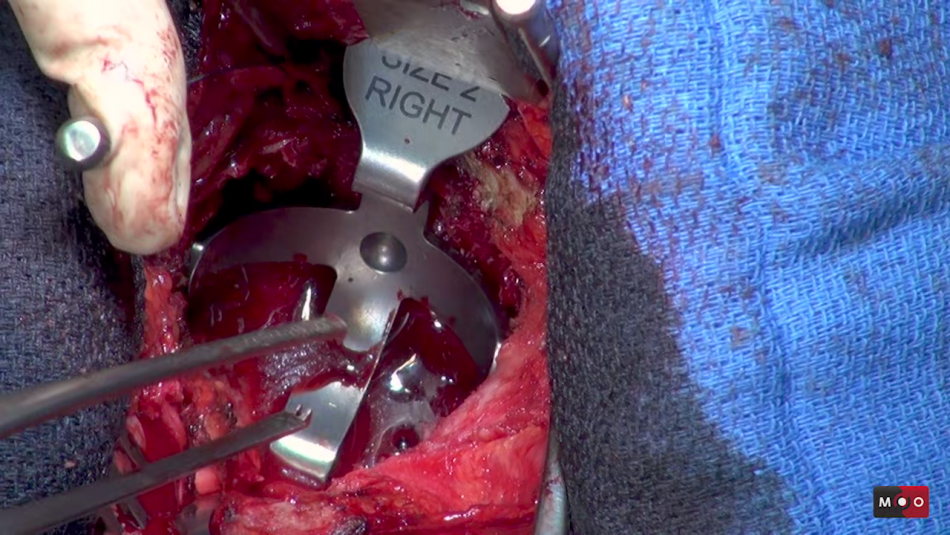 Technique de Reconstruction Cotyloïdienne par armature de Kerboull et allogreffe