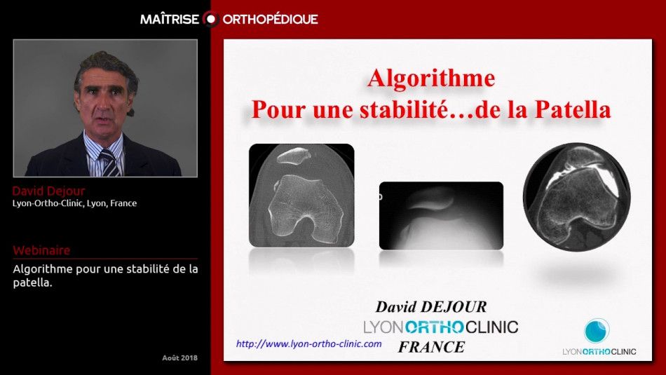 Algorithme pour une stabilité de la patella