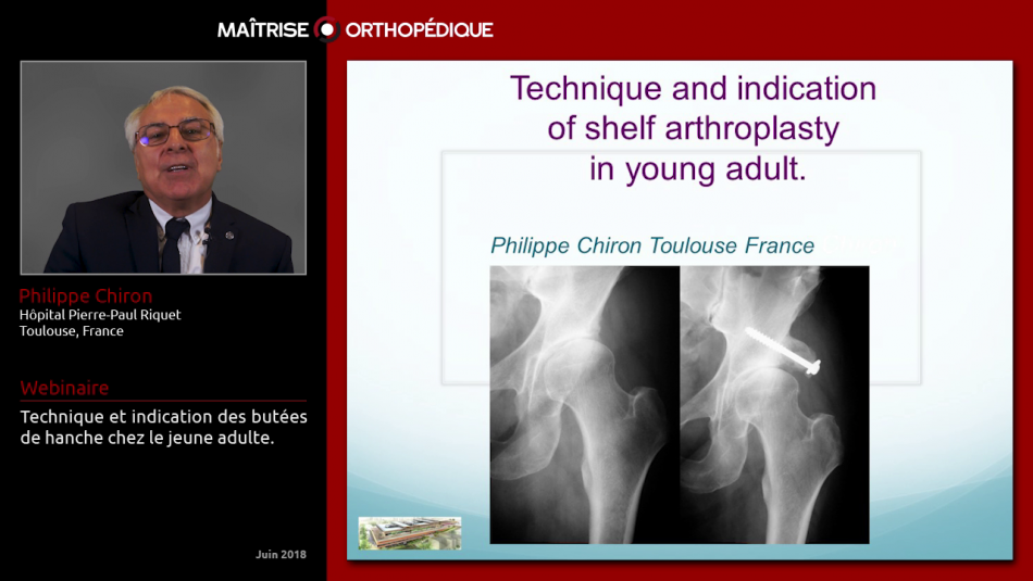 Technique et indication des butées de hanche chez le jeune adulte.