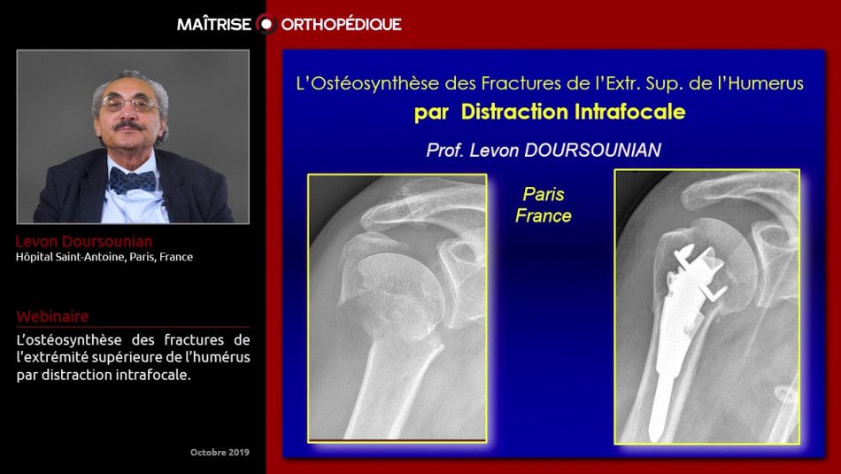 Ostéosynthèse des fractures de l'extrémité supérieure de l'humérus par distraction intrafocale