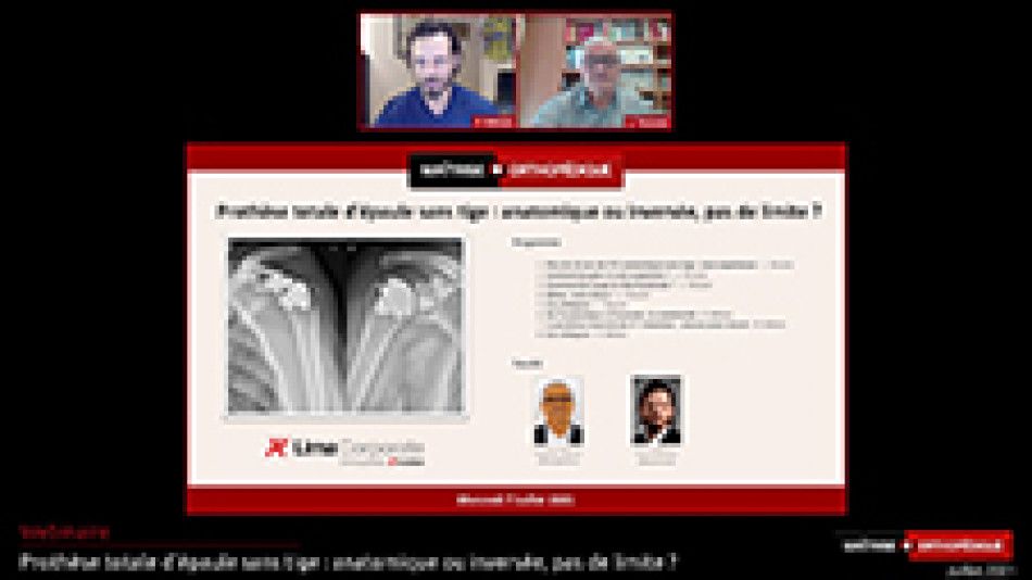 Prothèse totale d'épaule sans tige : anatomique ou inversée, pas de limite ?