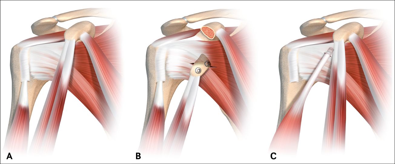 Stabilisation antérieure dynamique de l’épaule