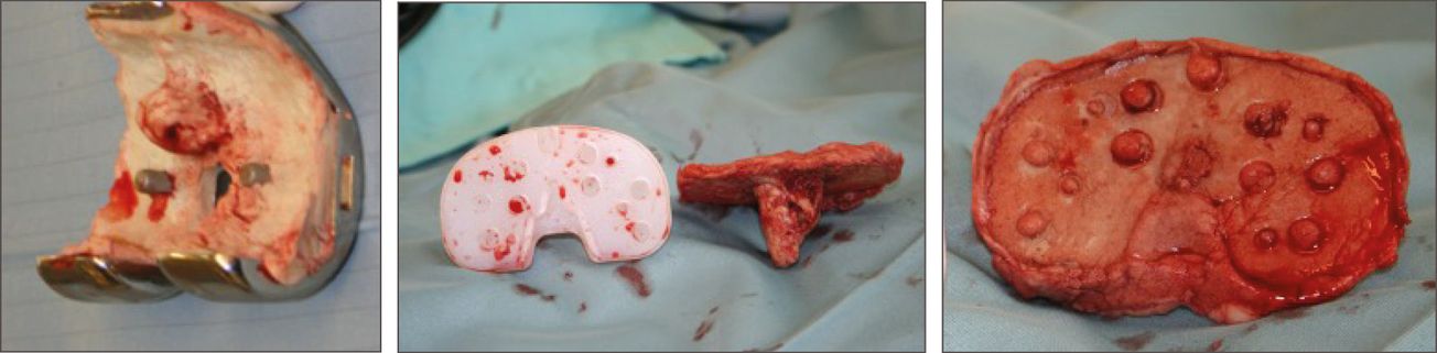 Utilisation de l'approche PTG en deux temps pour la prise en charge de l'arthrite septique active du genou avec une chondrolyse ou une ostéo-arthrite terminale sévère