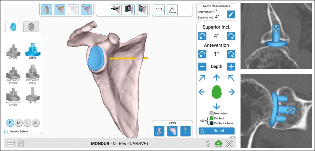 Prothèse totale d’épaule anatomique stemless Equinoxe avec navigation GPS