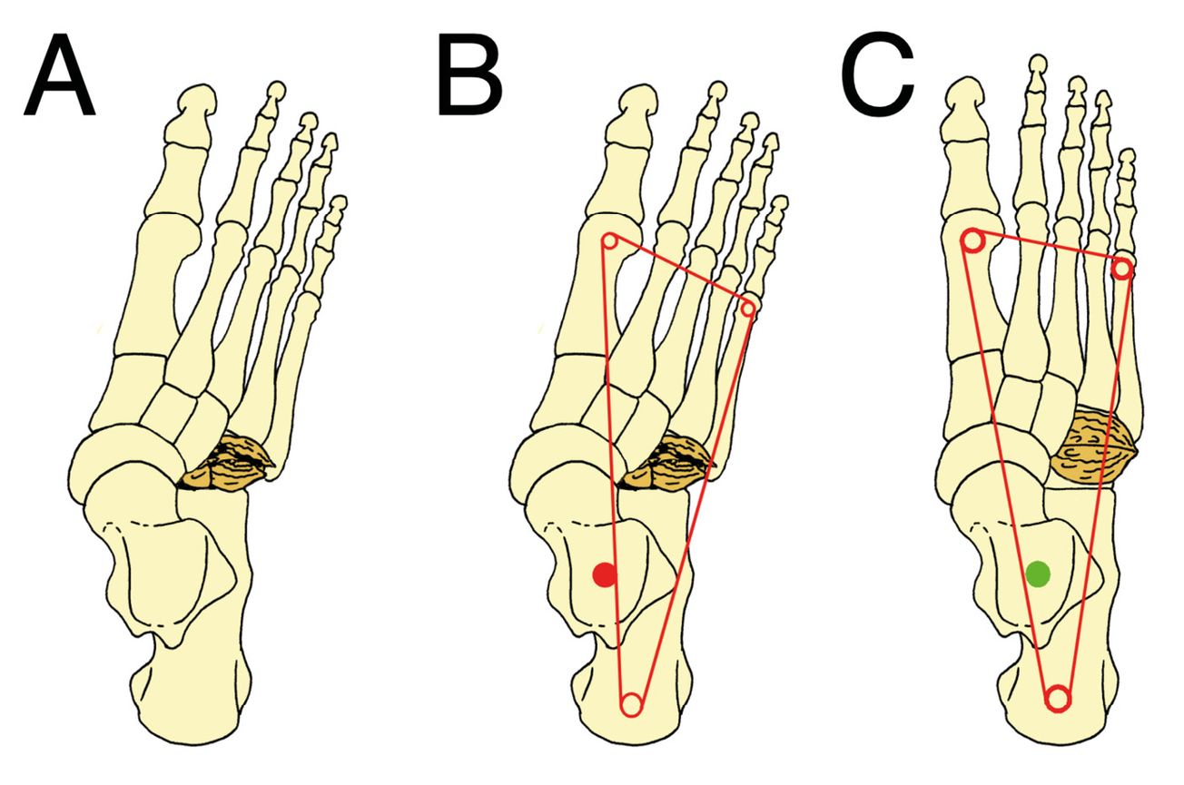 Grands principes de prise en charge chirurgicale des fractures des os de l’arrière-pied : calcanéus, talus, os cuboïde et os naviculaire