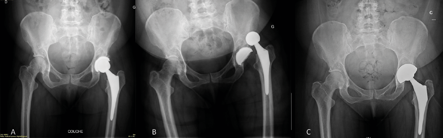 Les systèmes double mobilité en révision des prothèses totales de hanche