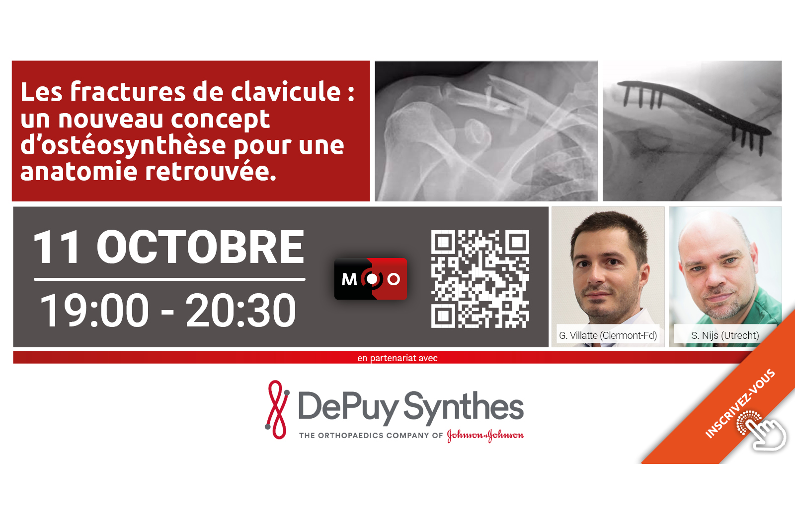 Webinaire à venir : Les fractures de clavicule, un nouveau concept d’ostéosynthèse pour une anatomie retrouvée.