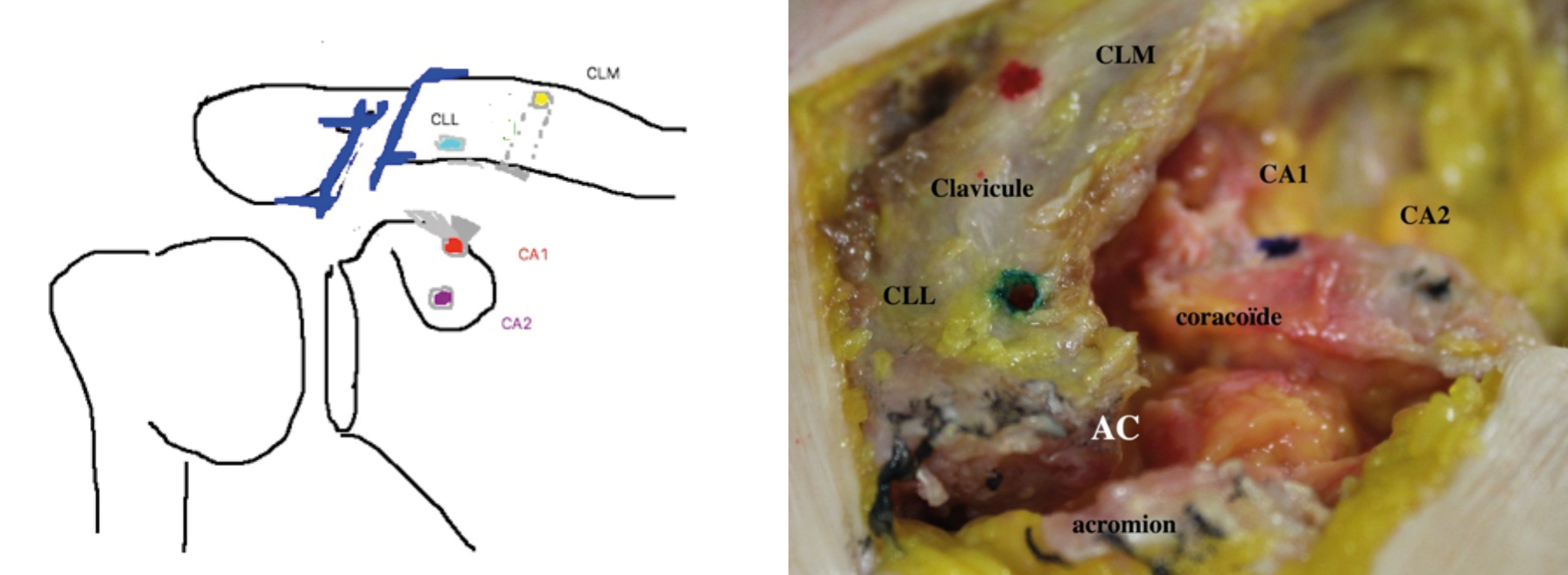 Comment optimiser la réduction acromio-claviculaire lors d’une ligamentoplastie pour disjonction acromio-claviculaire ? Intérêt d’une reconstruction anatomique du ligament conoïde