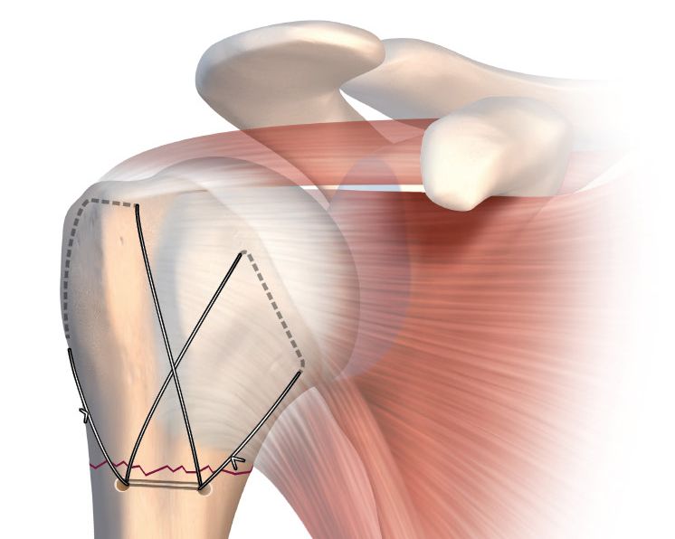 Point technique sur les ostéosutures des fractures de l’extrémité supérieure de l’humérus (ESH) et clou