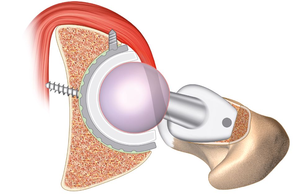 Conflits des prothèses de hanche avec le muscle ilio-psoas