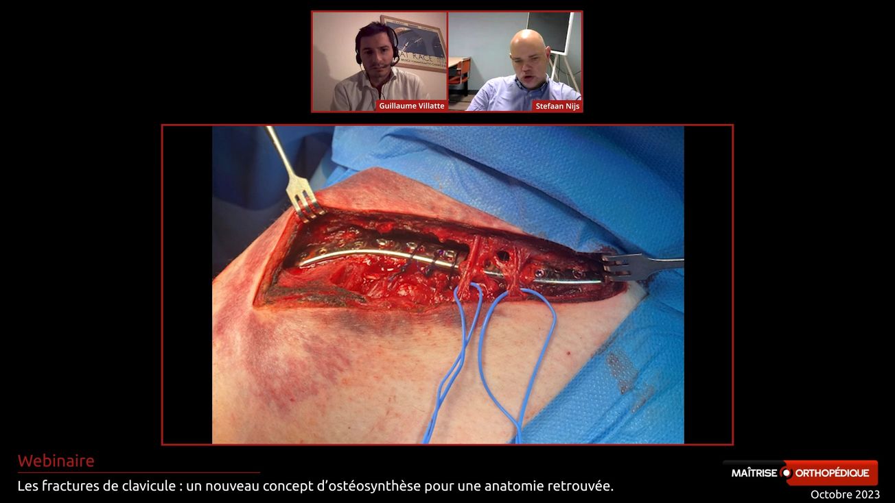 Les fractures de clavicule : un nouveau concept d'ostéosynthèse pour une anatomie retrouvée