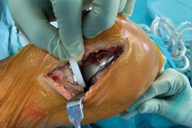 Actualisation du traitement des infections sur prothèses unicompartimentales du genou