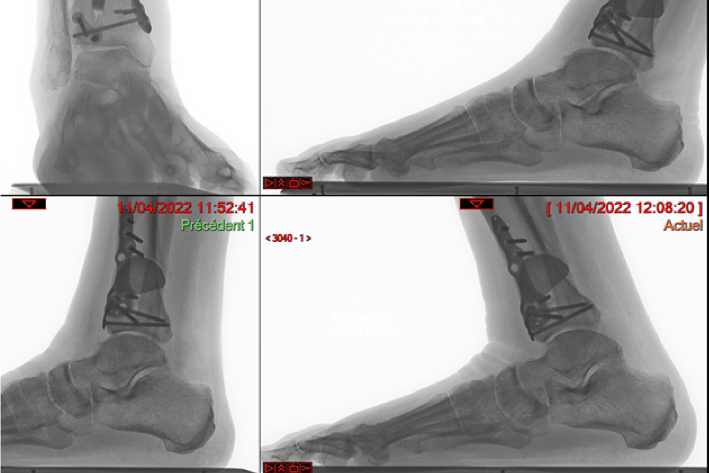 Ostéotomie hémicylindrique de Watanabe du tibia distal