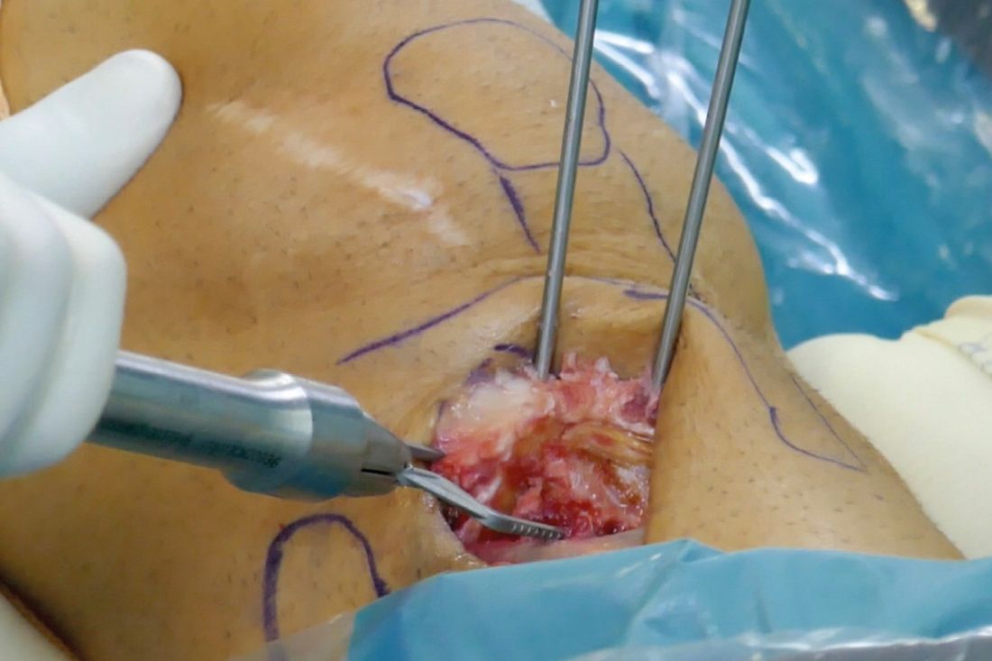 Ostéotomie de correction d'une déformation tibiale supra-tubérositaire : pour la prise en charge de l'instabilité fémoro-patellaire liée à une torsion tibiale excessive