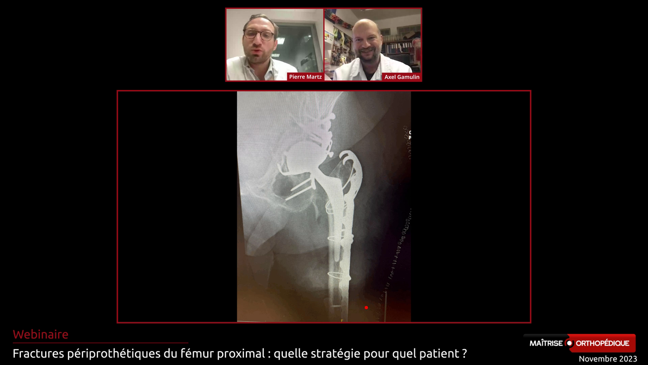 Fractures périprothétiques du fémur proximal : quelle stratégie pour quel patient ?