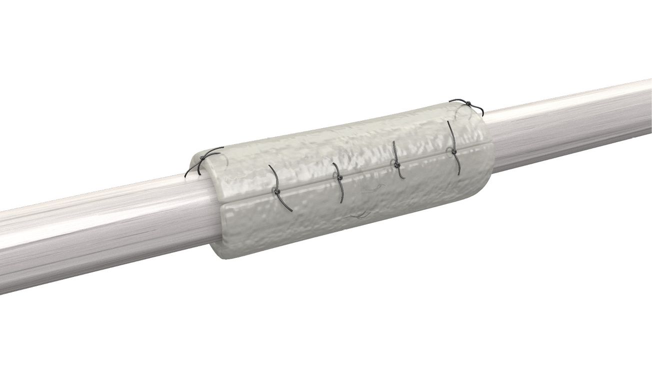 Utilisation des conduits de régénération nerveuse dérivés de vaisseaux de cordon ombilical humains (NerVFIX®) dans le traitement des sections nerveuses à la main