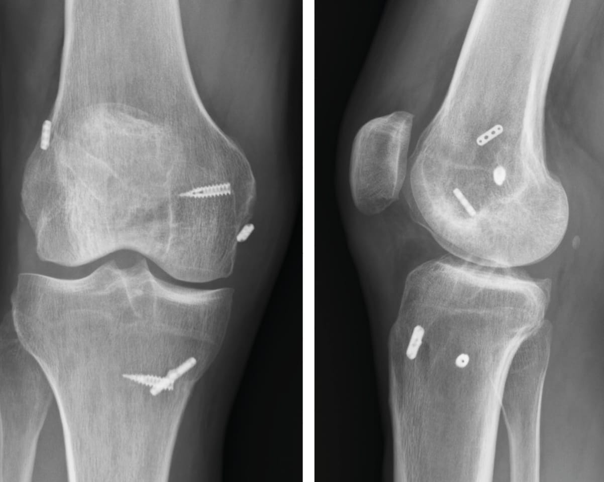 Planification chirurgicale et organisation de la prise en charge des lésions multi-ligamentaires du genou