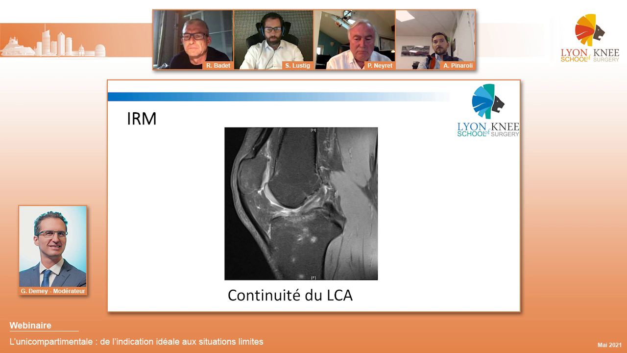 L'unicompartimentale : de l'indication idéale aux situations limites