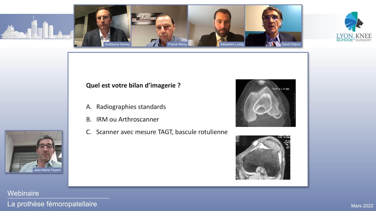 La patella #3 - La prothèse fémoropatellaire