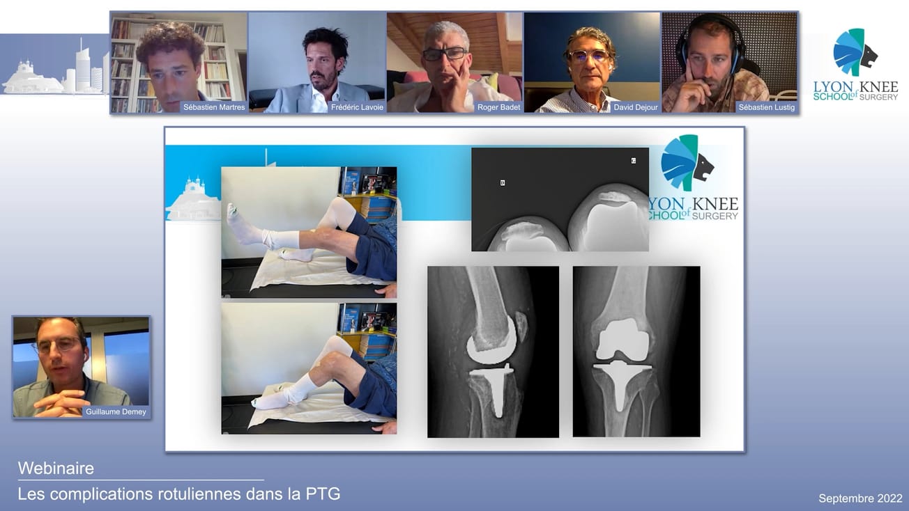 La patella #5 - Les complications rotuliennes dans la PTG