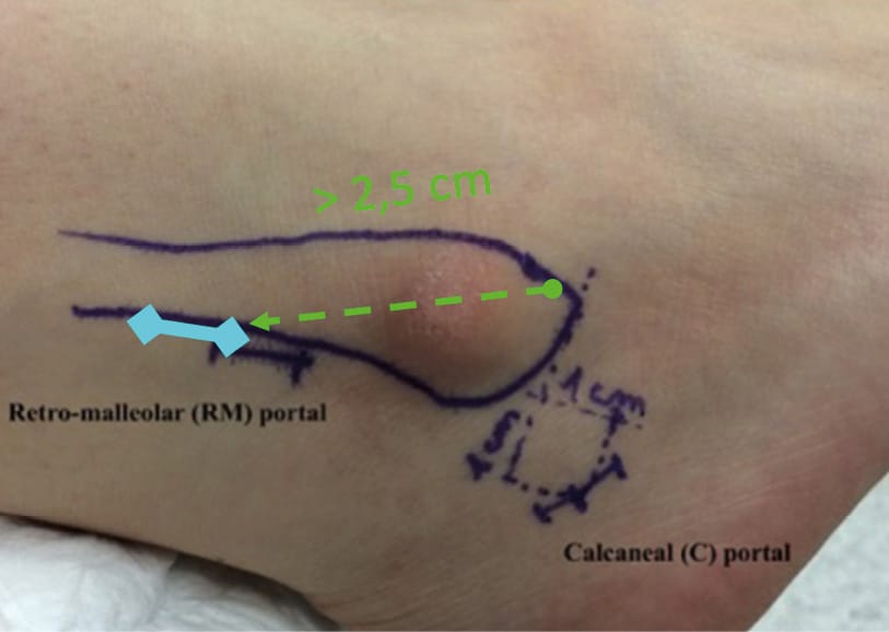 Focus sur la ligamentoplastie anatomique arthroscopique : gags et cas cliniques
