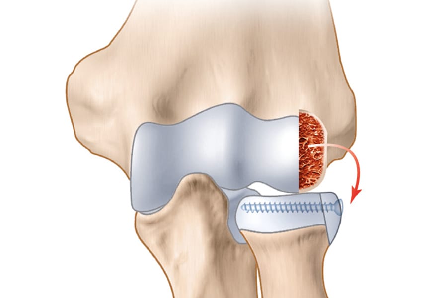 Reconstruction de la tête radiale par une greffe du condyle latéral