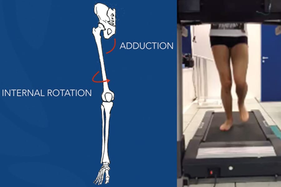 Prise en charge de la chondropathie fémoro-patellaire dans l’instabilité patellaire objective sur dysplasie de trochlée