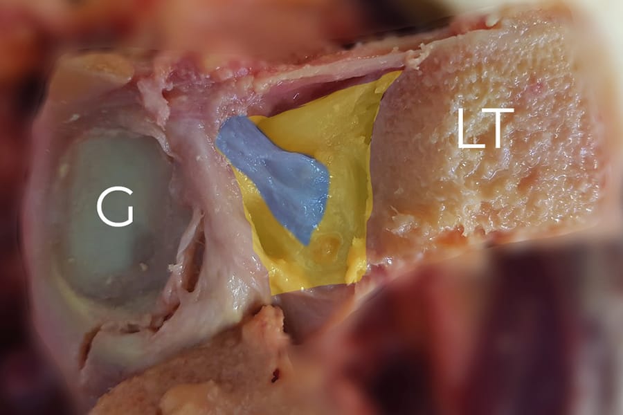 Les lésions du sous-scapulaire