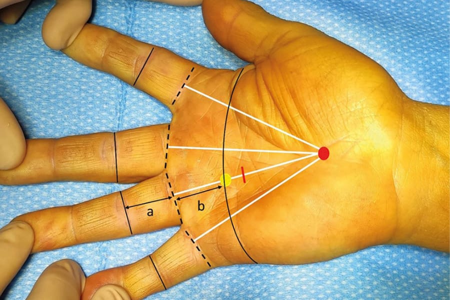 Prise en charge des doigts longs à ressaut en technique écho-guidée