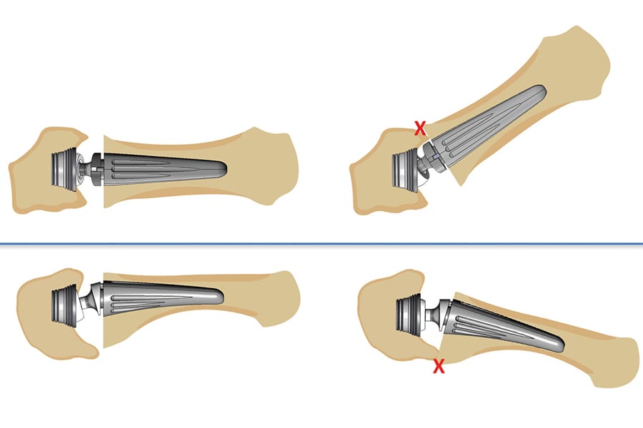 Prothèse totale trapézo-métacarpienne : guide radio-clinique & technique chirurgicale