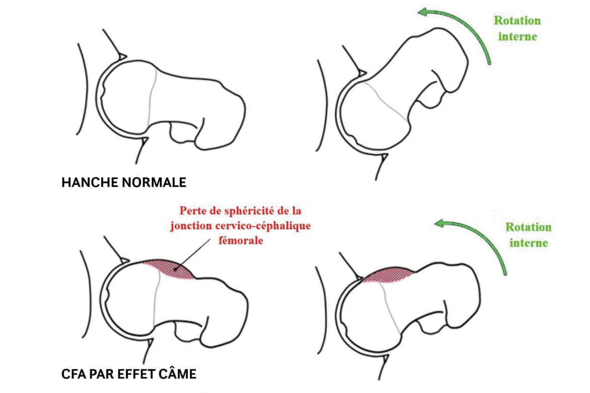 Comment faire le diagnostic d’un conflit fémoro-acétabulaire ?