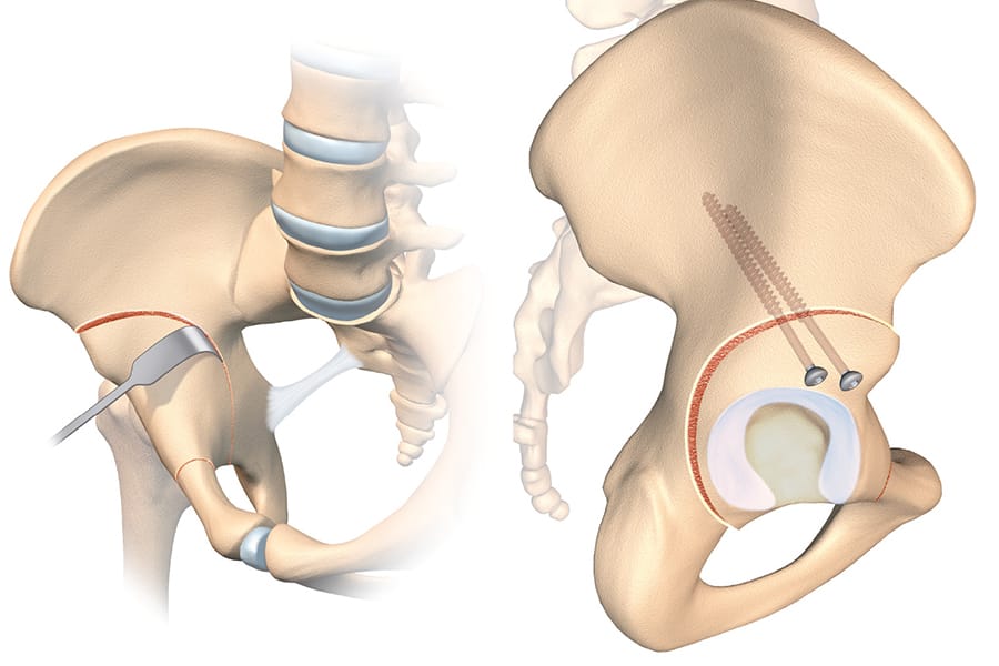La dysplasie de hanche, quel traitement en 2024