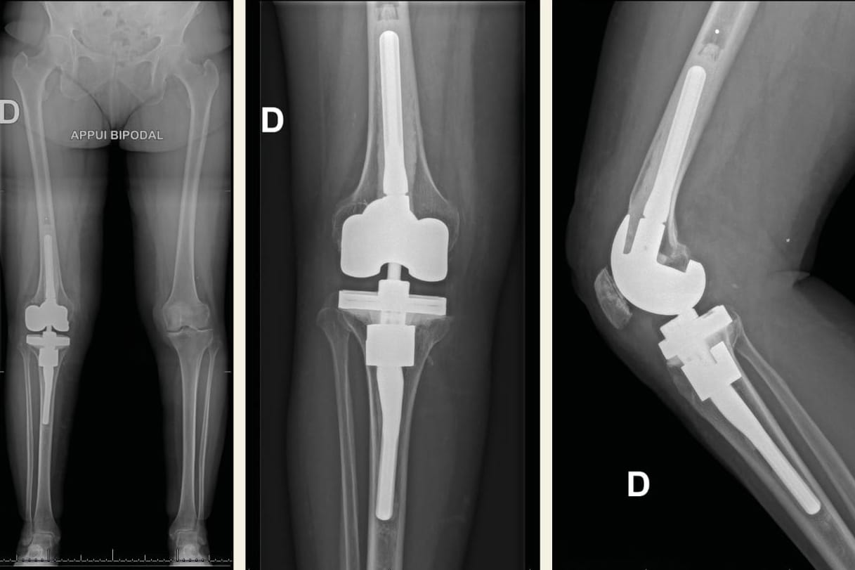 Comment diagnostiquer une instabilité fémoro-tibiale prothétique sur PTG