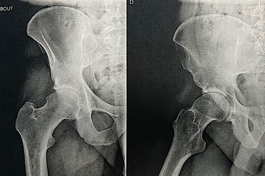 Place de la chirurgie prothétique dans le conflit fémoro-acétabulaire ?