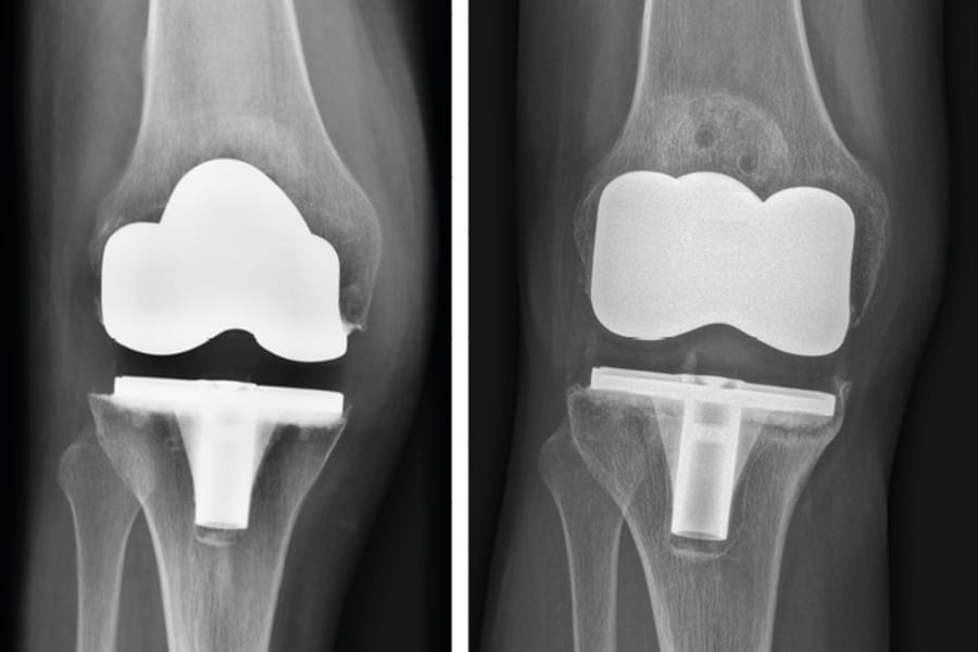 Défaut de fixation des PTG ?