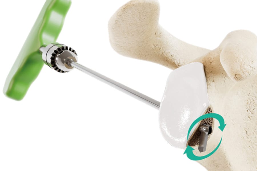 Butée claviculaire sous arthroscopie