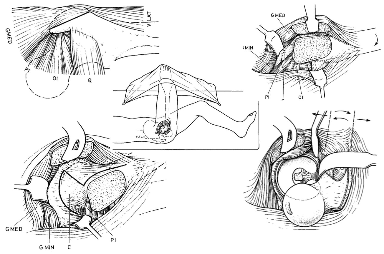 Quel traitement chirurgical conservateur dans le conflit fémoro-acétabulaire ?