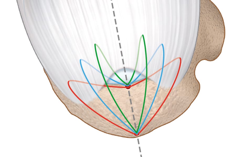 Réparation arthroscopique sans nœud du supra-épineux : la technique du parachute