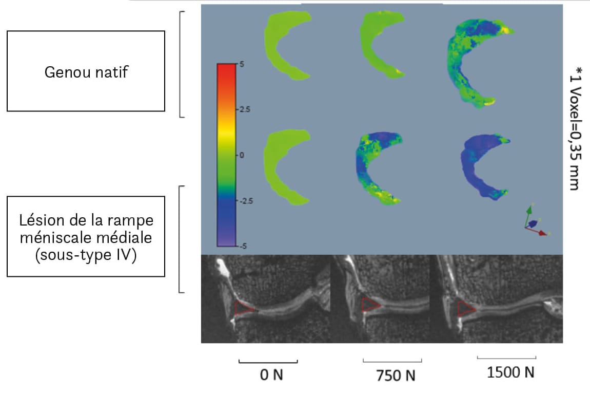 Une lésion de la rampe du ménisque médial augmente l’extrusion et la mobilité du ménisque