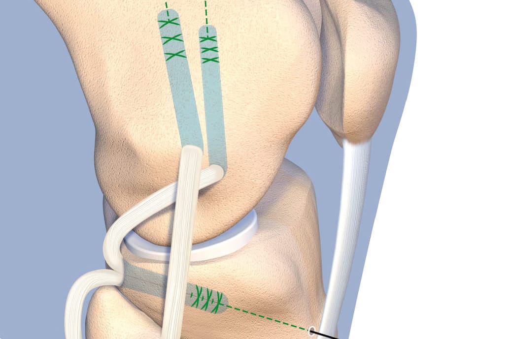 Comment prendre en charge une atteinte combinée du pivot central et du point d’angle postéro-latéral