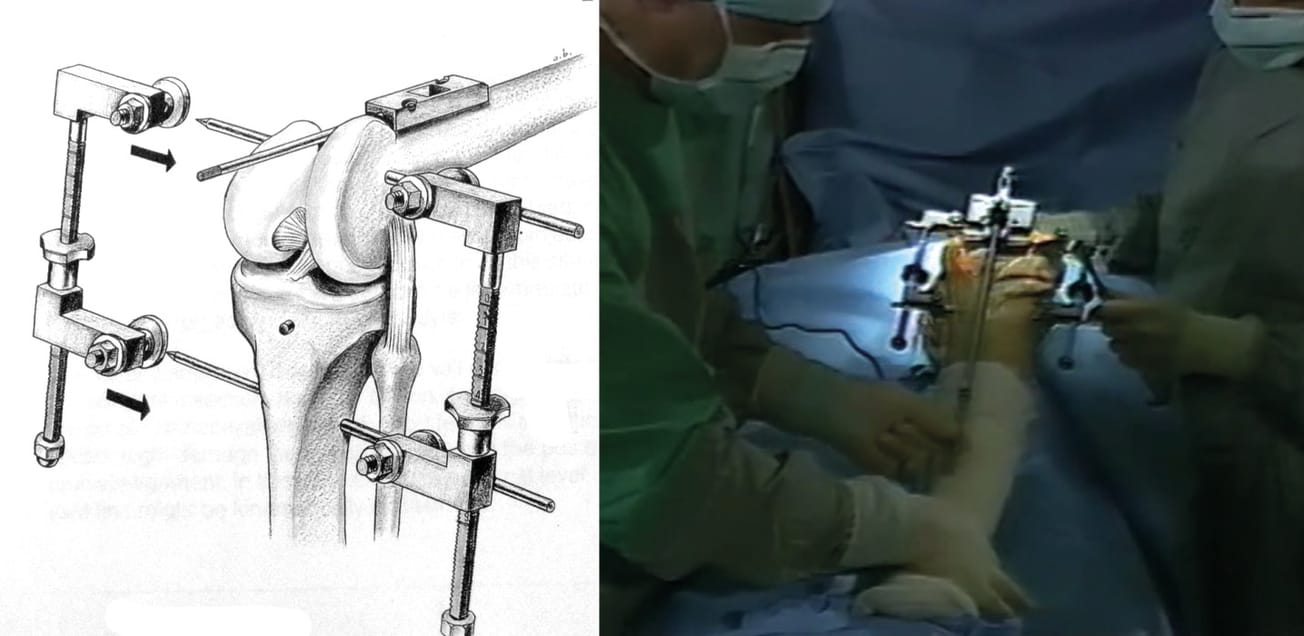 Prothèse totale du genou à préservation des deux ligaments croisés