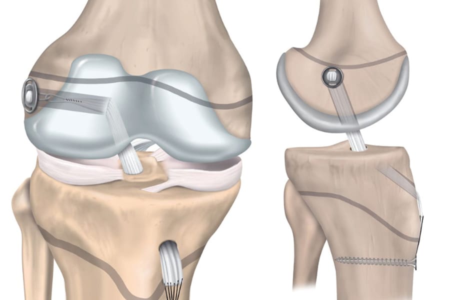 Prise en charge des ruptures intra-ligamentaires du LCA chez l’enfant et l’adolescent en croissance