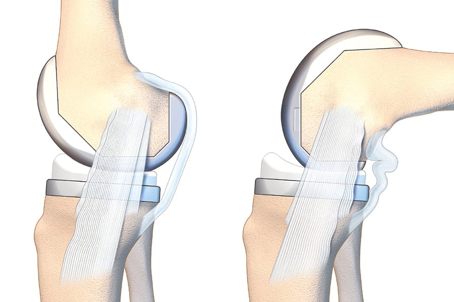 Comment je répare un ligament collatéral médial sectionné lors d’une PTG ?