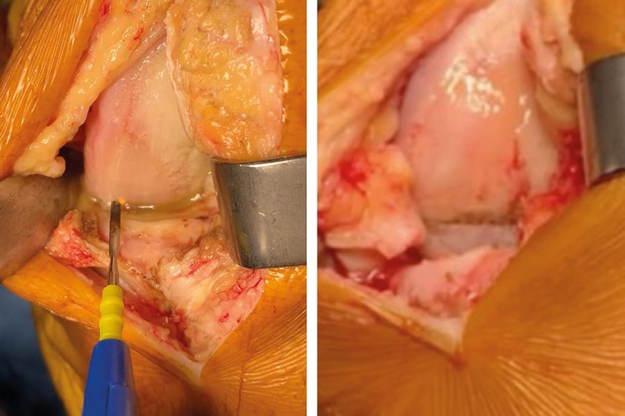 La « skyline brestoise », outil de vérification des résections osseuses tibiales et fémorales dans les prothèses unicompartimentales médiales