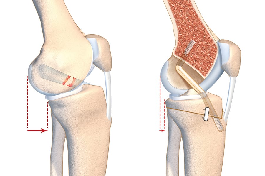 Interaction entre ligament croisé antérieur et pente tibiale : quelle place pour l’ostéotomie sagittale ?