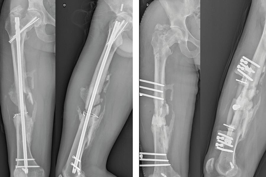 Pseudarthrose du fémur ou du tibia : prise de greffe avec le système RIA sur l’os pseudarthrose